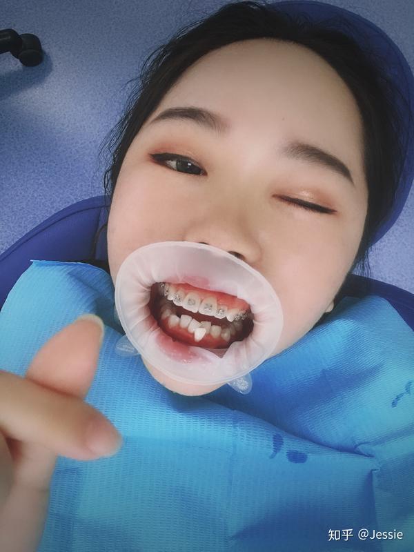 钢牙妹妹的日记 emmmmmm