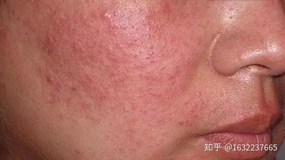 资深皮肤管理七老小赖说激素脸也有分类看看你是哪一种激素脸