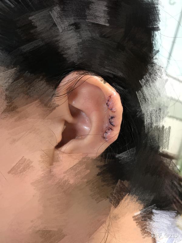 耳部瘢痕疙瘩治疗记录