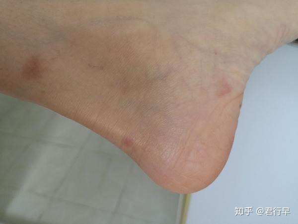 丘疹性荨麻疹 像蚊子叮的,全身长,剧烈瘙痒,一个星期后会变黑