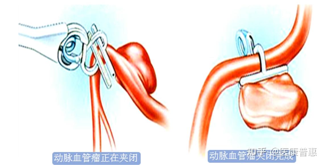 动脉瘤是由于动脉壁的病变或损伤,形成动脉壁局限性或弥漫性扩张或