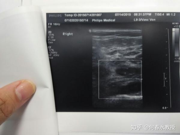 呈非凹陷性,张力较高,皮肤无发红,皮温高,右下肢腓肠肌压痛,homan'