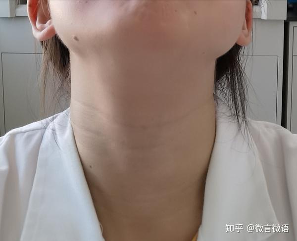 这颈纹还有救吗?