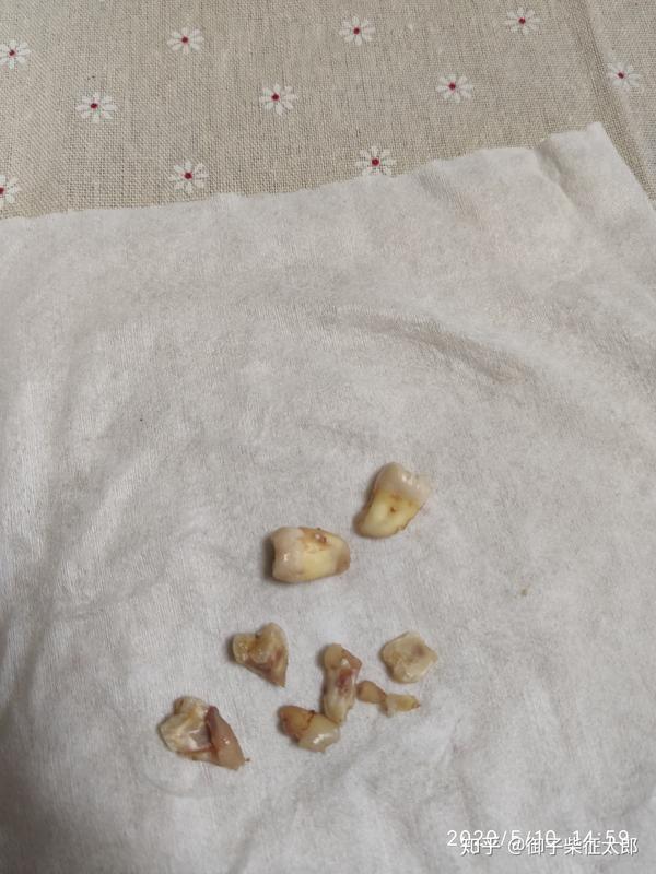 住院全麻一次性拔四颗智齿