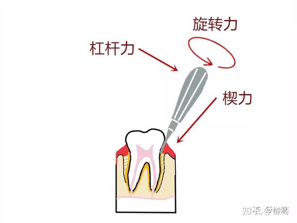 并不是力气大就会拔牙 !拔牙需要技巧的亲 ! 这几种牙很难拔: 1.