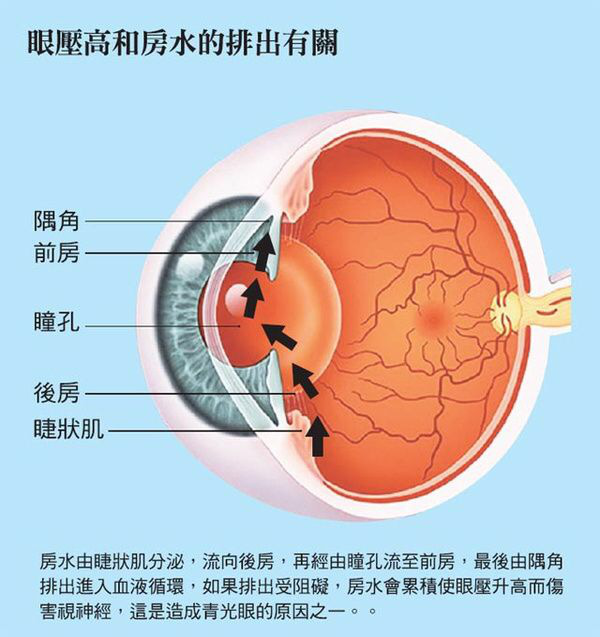 开角型青光眼