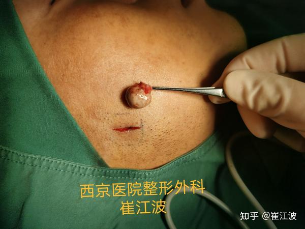 皮脂腺囊肿,俗称"粉瘤",整形外科可完整切除后美容缝合