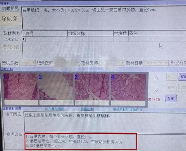 25岁肿瘤医院护士分享甲状腺癌淋巴转移经历:坚强面对