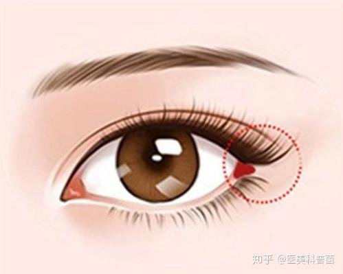 外眼角怎么修复