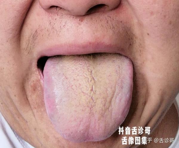 抖音舌诊哥:舌诊知健康,教你学会看舌象系列四十一