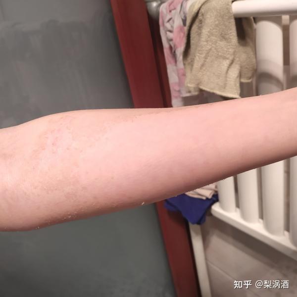 浅二度烫伤恢复情况