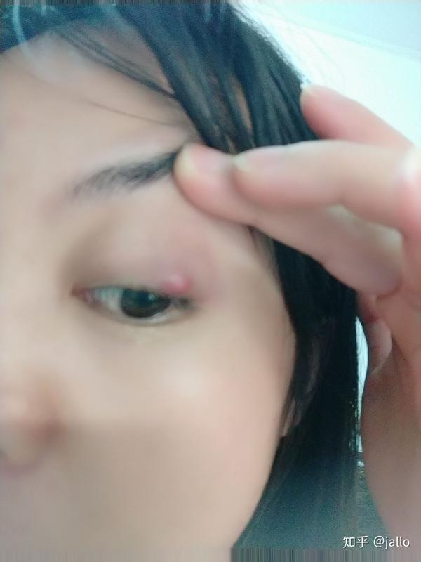 记一颗扰乱我生活的麦粒肿