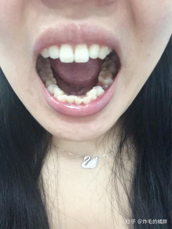大龄男女青年牙齿正畸并拔牙的过程感觉