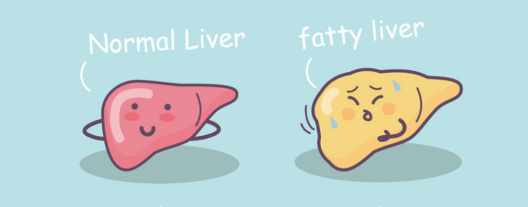 「脂肪肝」可能逆转,也可能变癌!这3点很关键