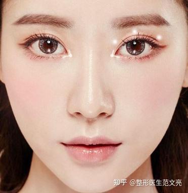 为什么开外眼角会回缩