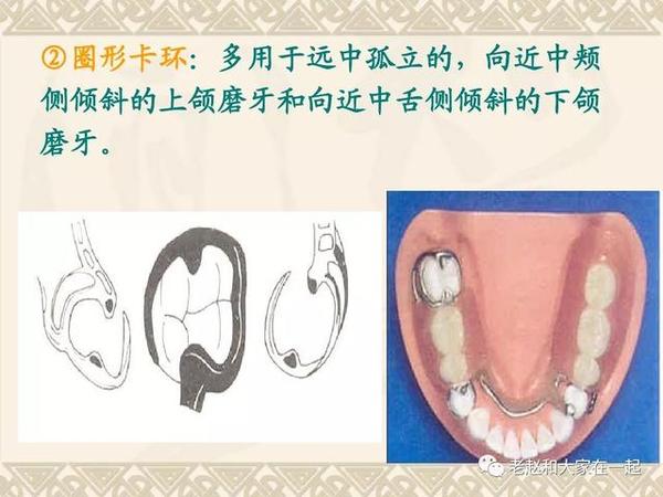 决胜2020医考│五星难度口腔修复卡环设计题