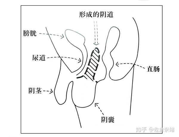 2)ftmsrs(从女性到男性的性别重置手术) (1)乳房的手术(乳腺组织切除