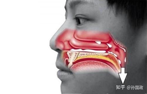 耳鼻喉科孙国政医生:鼻后滴漏综合征是怎么回事?