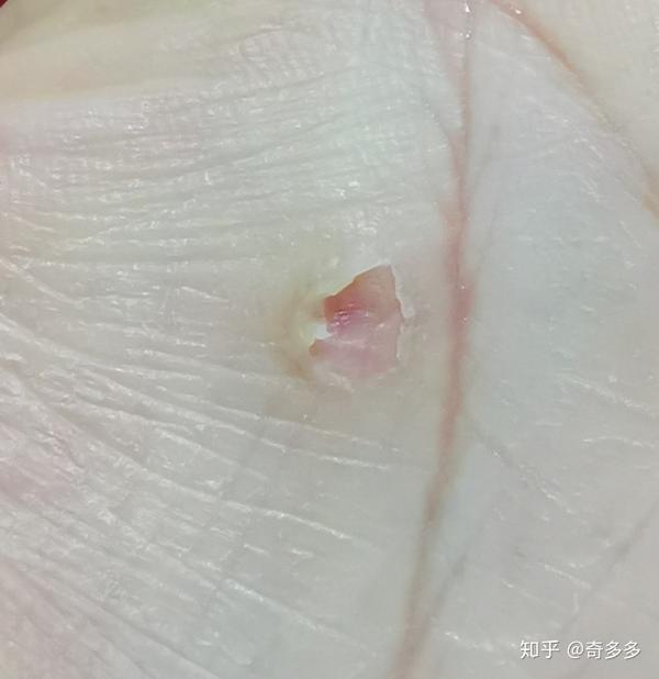 寻常疣治疗-安全廉价方法