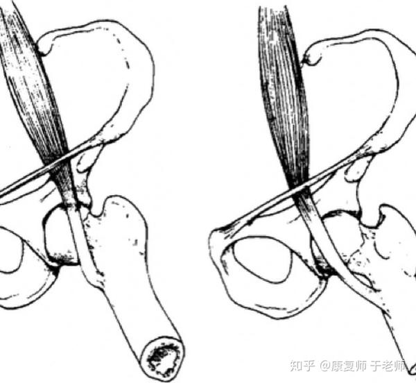 骶髂关节紊乱引起的生物力学改变和髋关节肌肉不平衡与内侧型弹响髋也