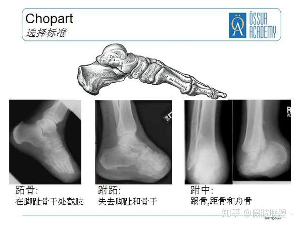 半足假肢介绍假肢联盟友情提供