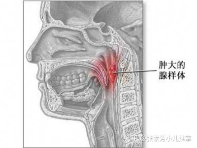 五,西医对腺样体肥大的治疗办法