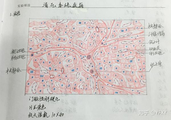 红蓝铅笔图绘图,b.镜下照片. 包含:1.肉芽组织,2.慢性肺淤血,3.