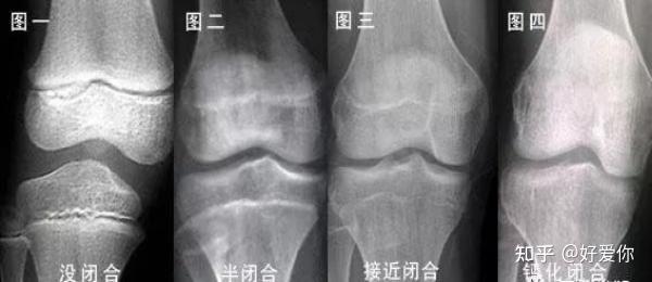 骨骼线闭合有哪些表现?