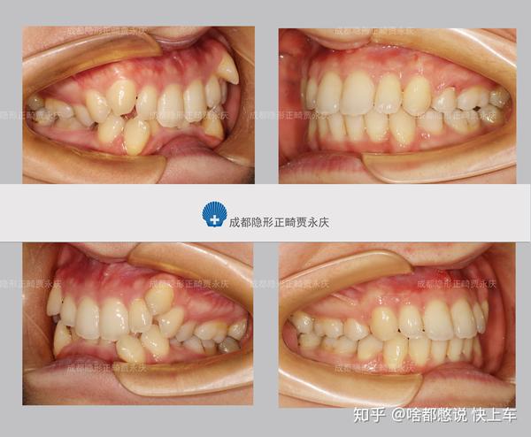 圣贝牙科贾永庆医生的深覆合病例,大家可以看看他们在矫正前后牙齿,面