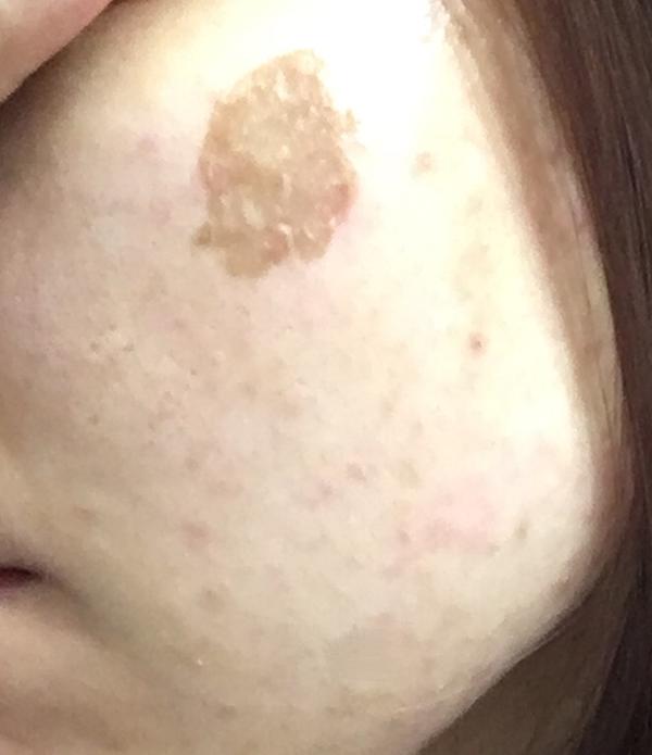 果酸换肤靠谱吗?会有哪些正面和负面作用呢?