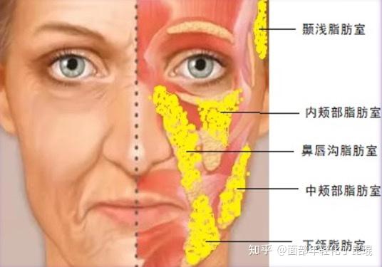 关于面部脂肪室|什么是面部脂肪室?