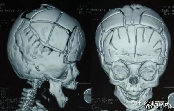 冠状缝旱闭导致斜头畸形:常有明显的眼眶距增宽且眶浅,导致突眼;面