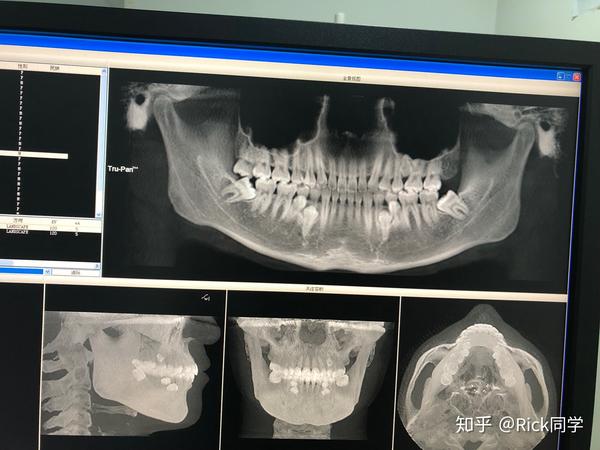 拔10颗牙和舌下腺囊肿手术经历上