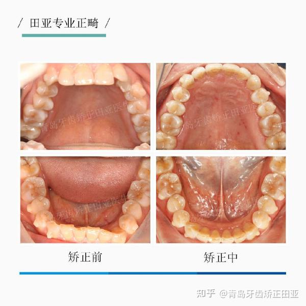 深覆合需要做矫正吗青岛牙齿矫正