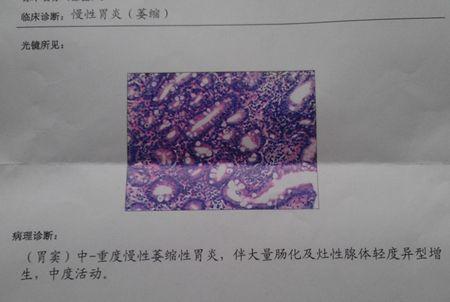 胃镜头部带有超声探头,可以了解病变侵犯胃壁的厚度,这就是胃癌的t