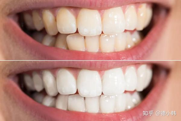 一笑就尴尬?超实用的牙齿美白方法了解下
