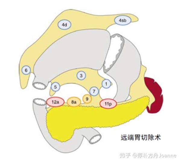 近端胃切除术