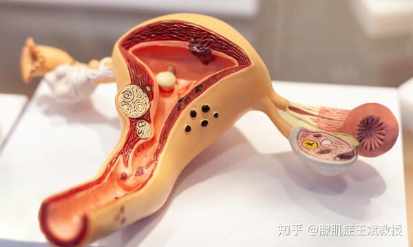 专家建议:"巧囊"达到4厘米时,最好尽快手术治疗!