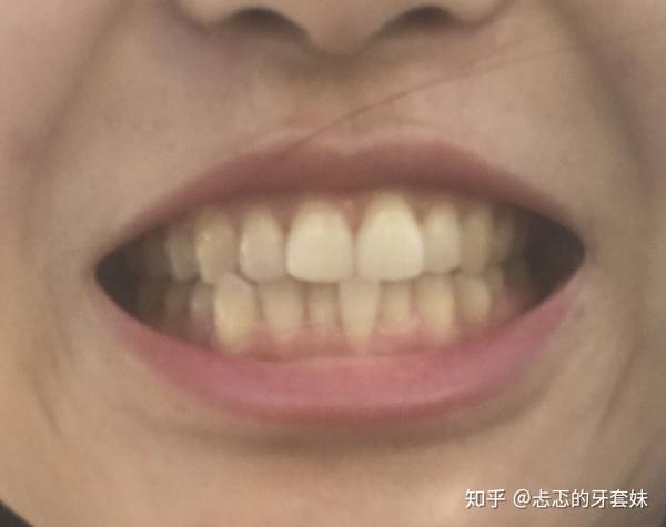 22may2019 去医院拔一颗下门牙 忐忑