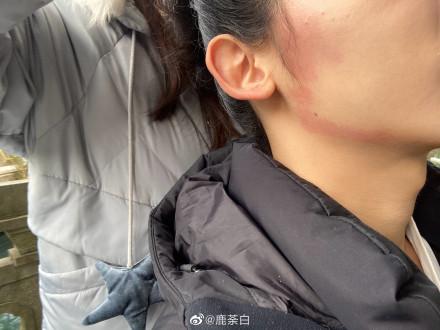 长期戴口罩引起的脸部过敏应该注意的事项还有如何修复肌肤