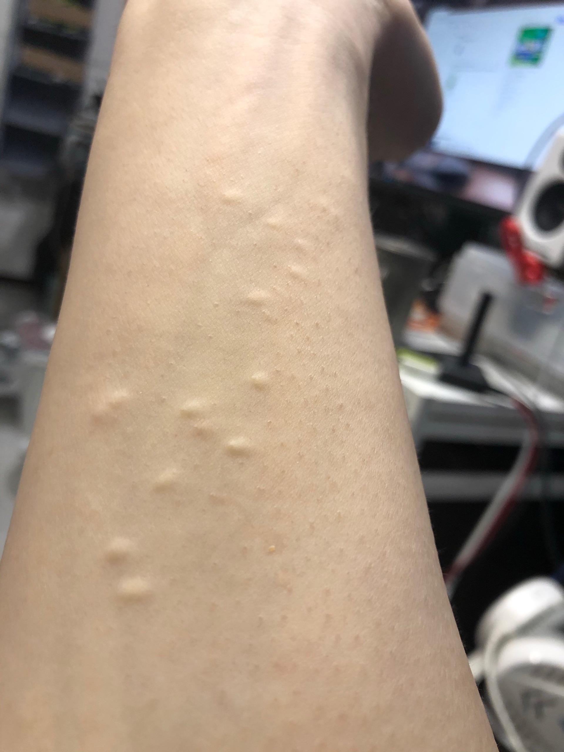 摸到了皮下小疙瘩了要不要紧