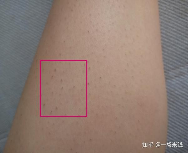 这是小腿,也是出现毛囊里的里的毛很多没有长出来,变成这种小黑点