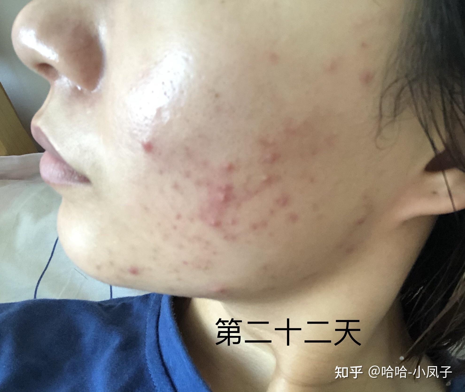 痘痘肌战痘记录
