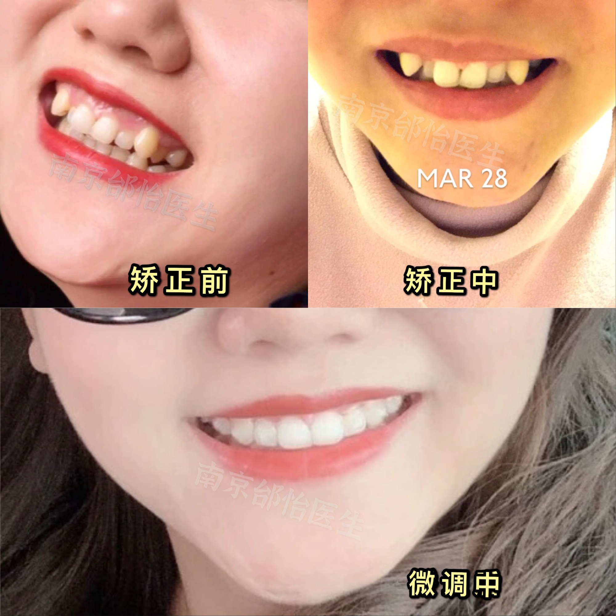 南京牙齿矫正|正畸对面部美观的改善大吗?