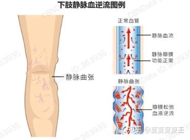 得了静脉曲张就真的没办法了吗?