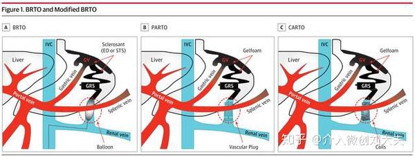 胃底静脉曲张介入微创治疗——brto