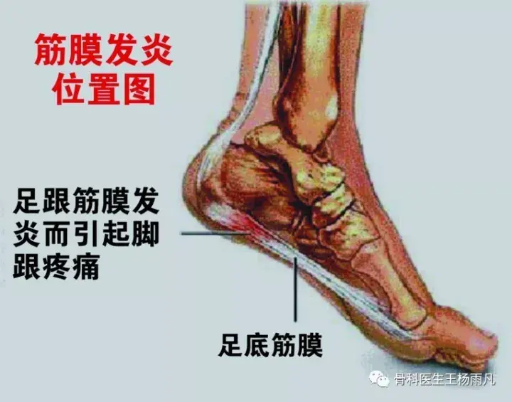 人群养生  上图中白色的条索状的是肌腱和筋膜,其中位于脚底板的那一