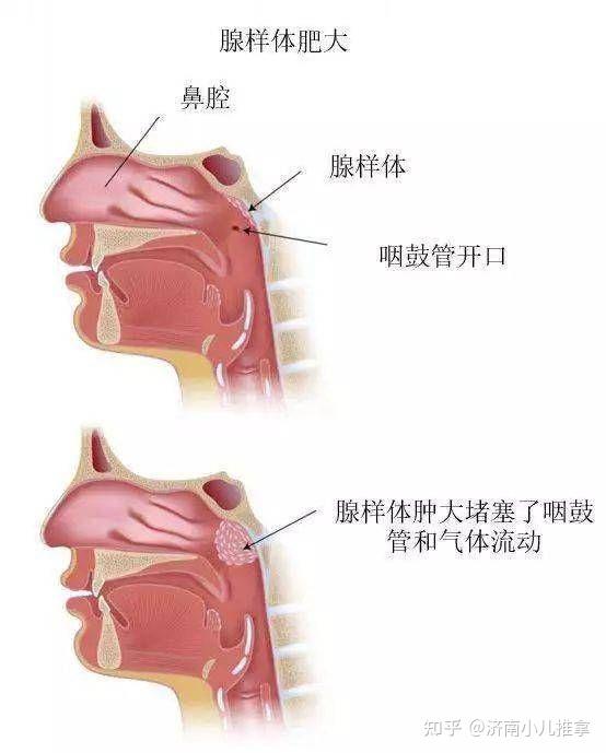 小儿推拿杨晓:什么是儿童腺样体肥大?必须要手术吗?如何调理?