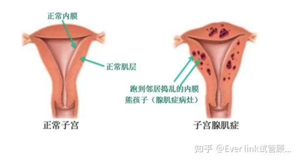 患子宫腺肌症,我还能有自己的宝宝吗?