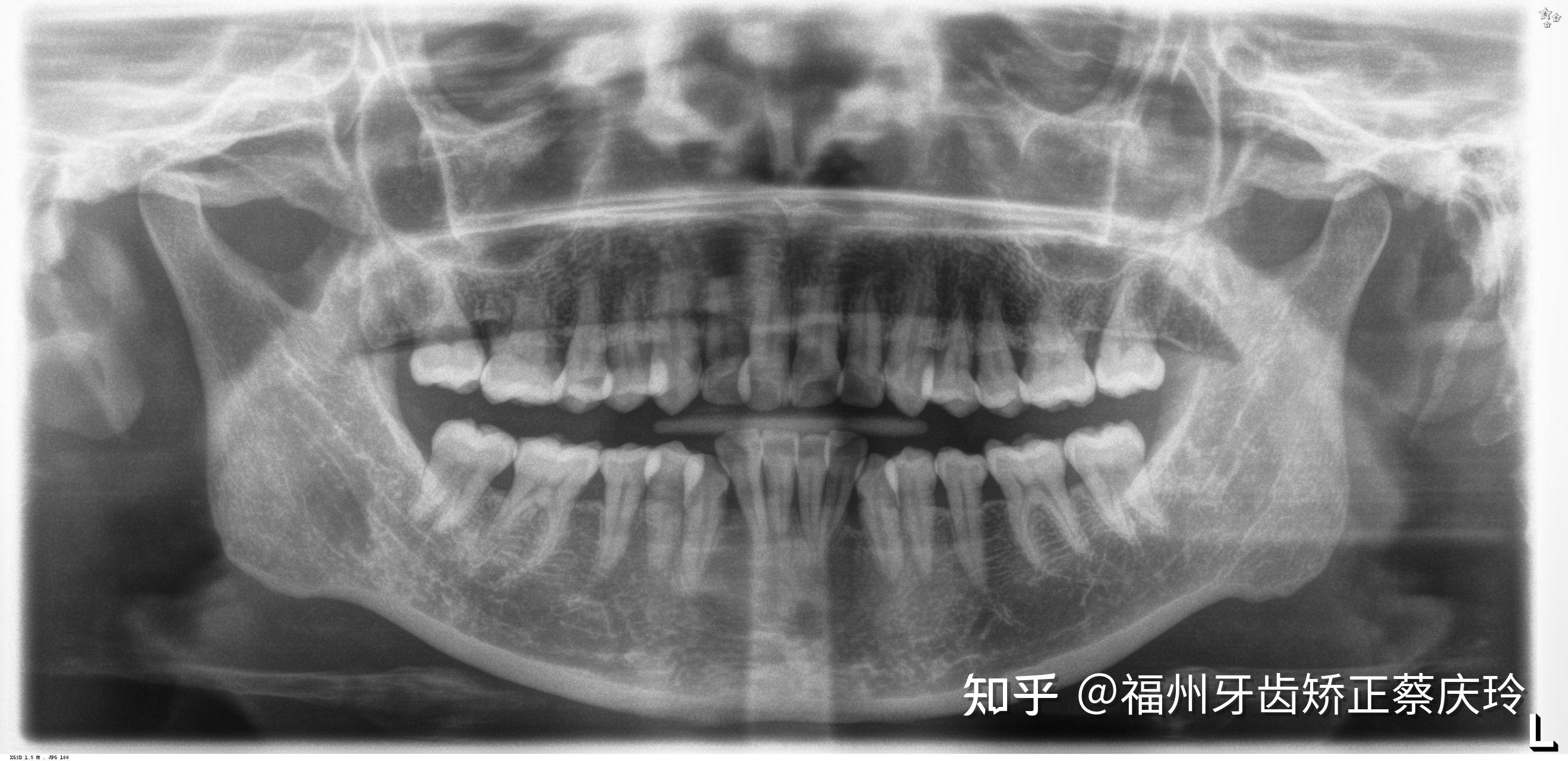 我们判断时是至少需要借助一张全景x光片和一张侧位x光片来对你的牙齿